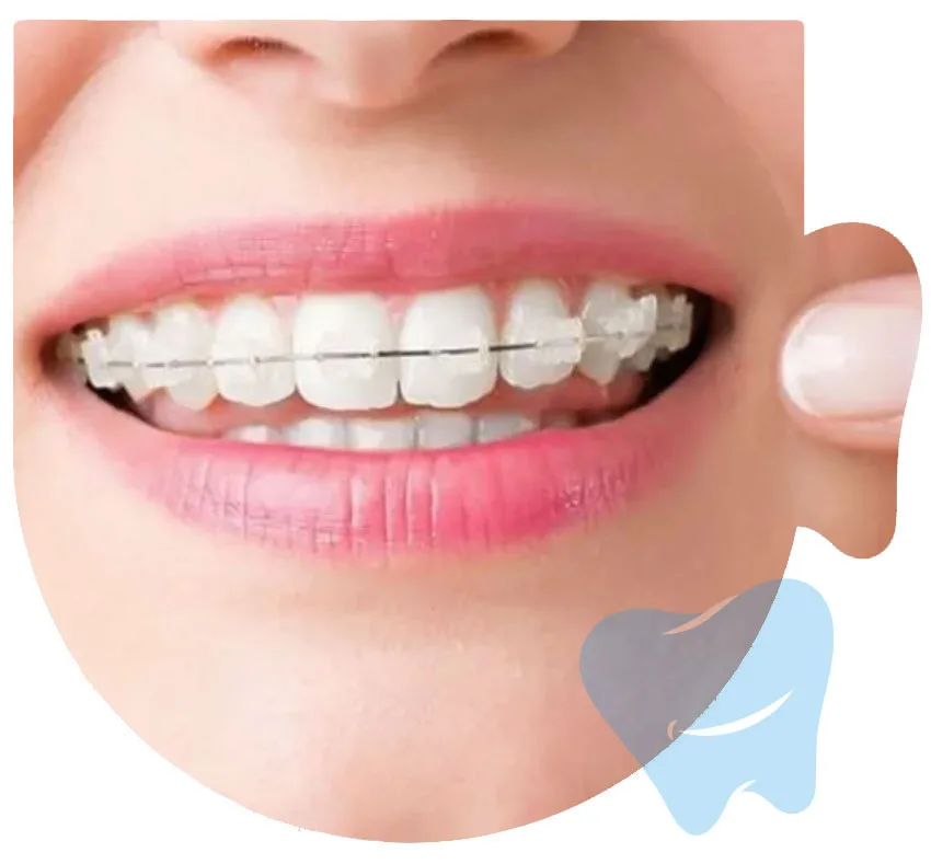 Clear braces treatment at CitiDental of Woodhaven